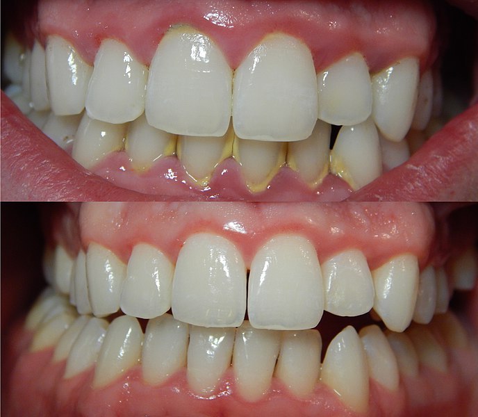 Gingivitis antes (arriba) y despus (abajo) de un detallado desbridamiento (aseo) mecnico de los dientes.