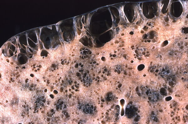 Tejido parenquimatoso pulmonar que muestra el dao debido a un enfisema. El neumotrax espontneo suele ser el resultado de la ruptura de tales lesiones. La fibrosis en panal est presente en el parnquima pulmonar subpleural