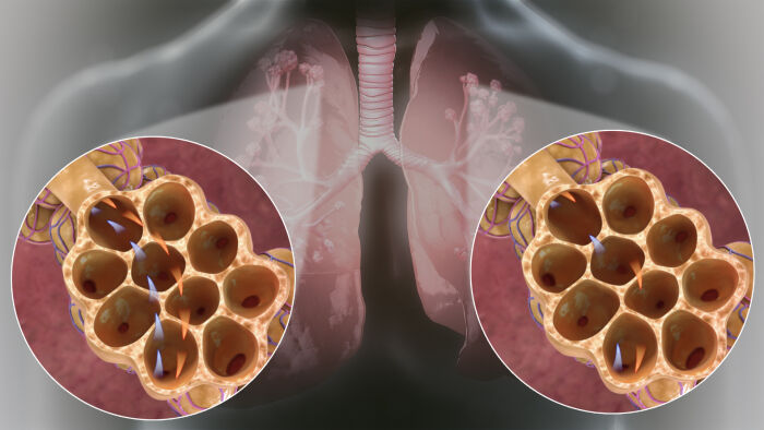 La hiperventilacin es el aumento del flujo de aire en los alvolos pulmonares debido a una respiracin rpida o profunda, mientras que la hiperpnea describe una respiracin ms rpida y profunda.