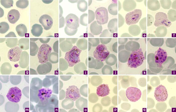 Microfotografas del Plasmodium vivax, causante de la cuartana