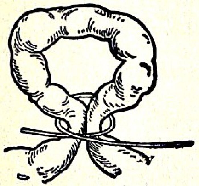 estrangulacin