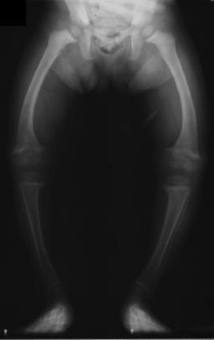 Radiografa de un nio estevado