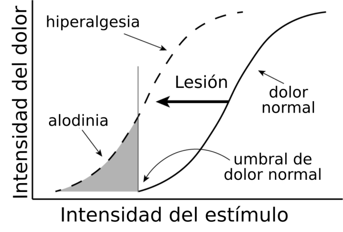 Alodinia