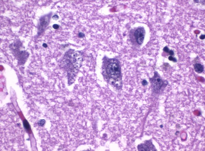 Histopatologa de la degeneracin granulovacuolar en el hipocampo en la enfermedad de Alzhimer