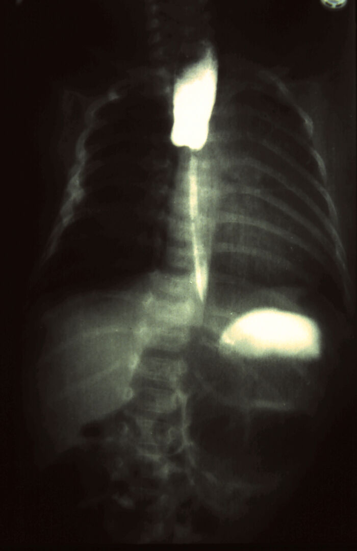 Serie gastrointestinal superior. Radiografa con contraste de atresia esofgica congnita