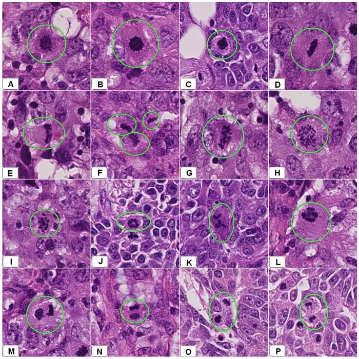 Instantneas de varios WSI de varias resecciones mamarias diagnosticadas previamente como un carcinoma ductal infiltrativo utilizando un microscopio ptico. Estas instantneas muestran diferentes apariencias de figuras mitticas rodeadas por crculos verdes. Los paneles A  C muestran clulas en metafase temprana. Los paneles D-G muestran diferentes formas de divisin mittica en la metafase tarda. El panel H  L muestra diferentes formas de anafase. Los paneles M  P muestran clulas en telofase.