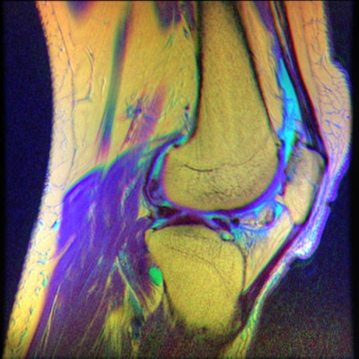 Imgenes de resonancia magntica de la rodilla que muestran condromalacia rotuliana.