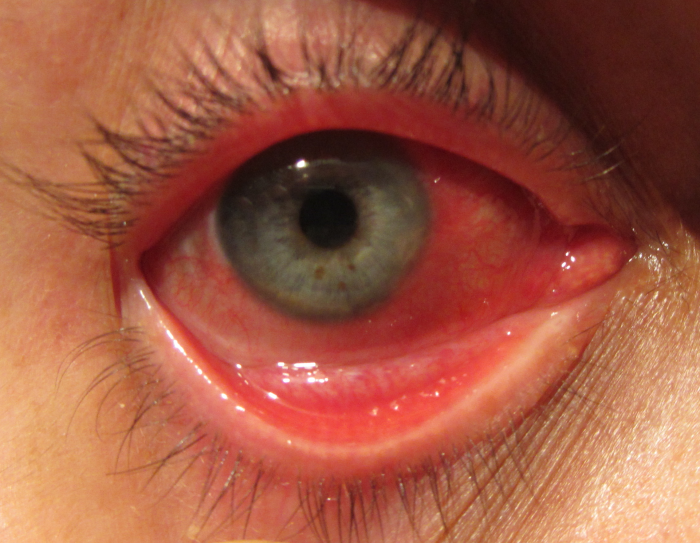 conjuntivitis