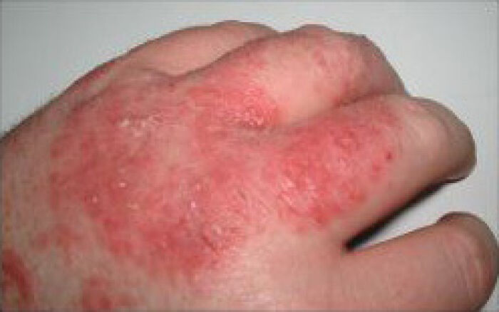 dermatitis