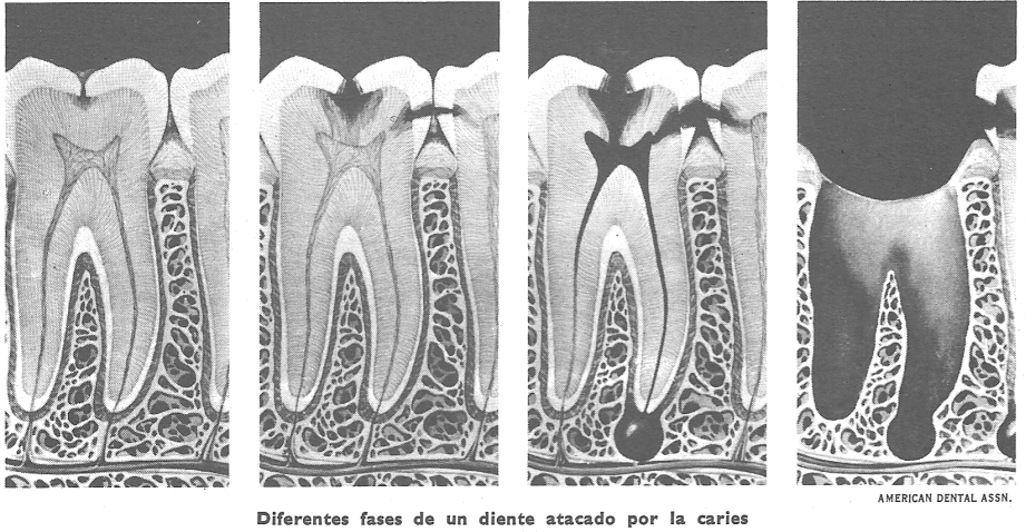 Dientes humanos: caries dental