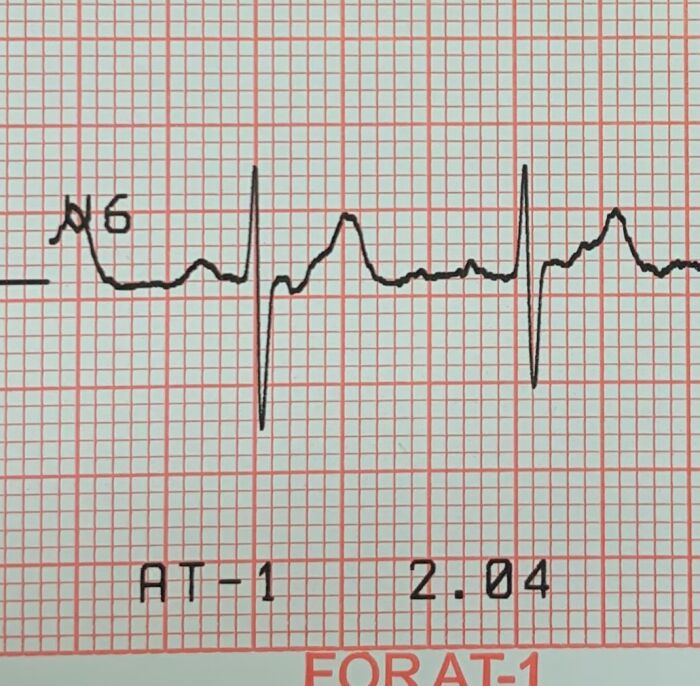 electrocardiograma