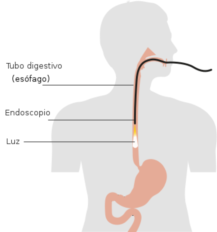 Diagrama que muestra una endoscopa