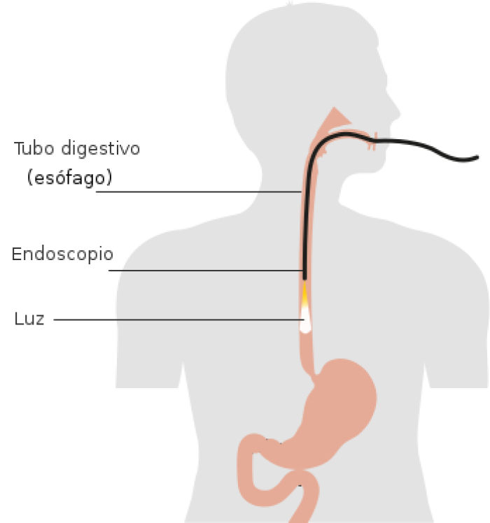 endoscopa