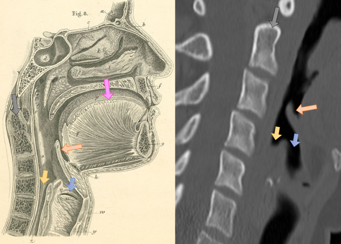 Epiglotis