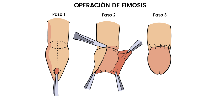 Operacin de la fimosis