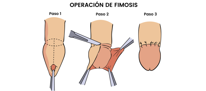 fimosis