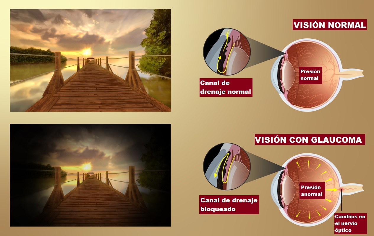 Explicacin esquemtica del glaucoma: cmo ve alguien con glaucoma?