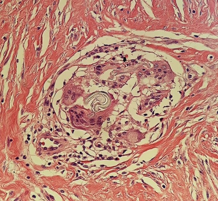 granuloma