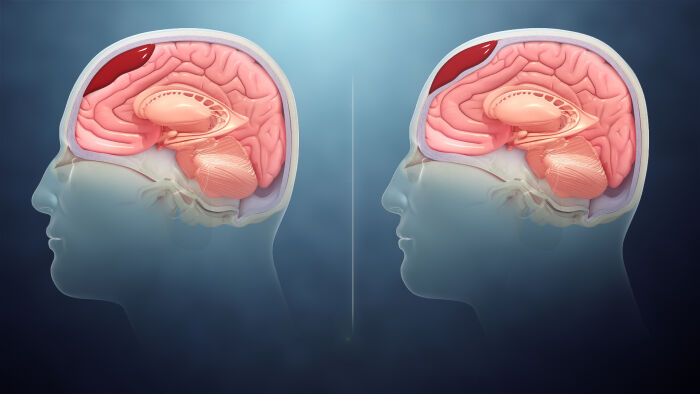 Hematoma intracraneal