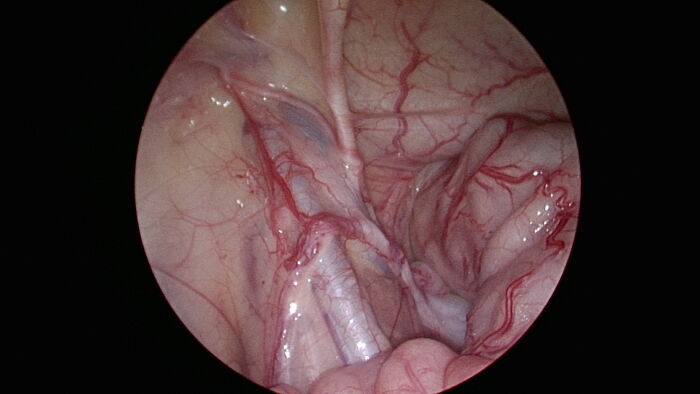 Una imagen obtenida por laparoscopa