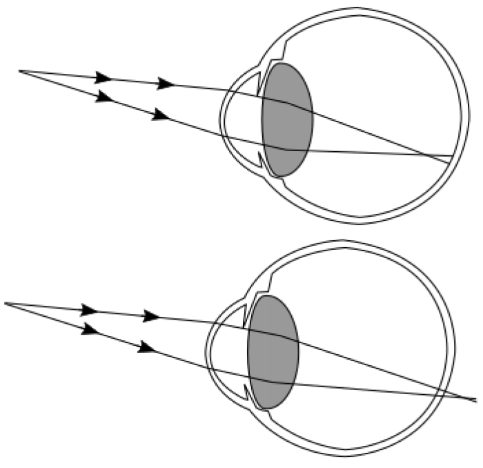 Ilustracin de los rayos de luz en la miopa (arriba) y en la hipermetropa (abajo)