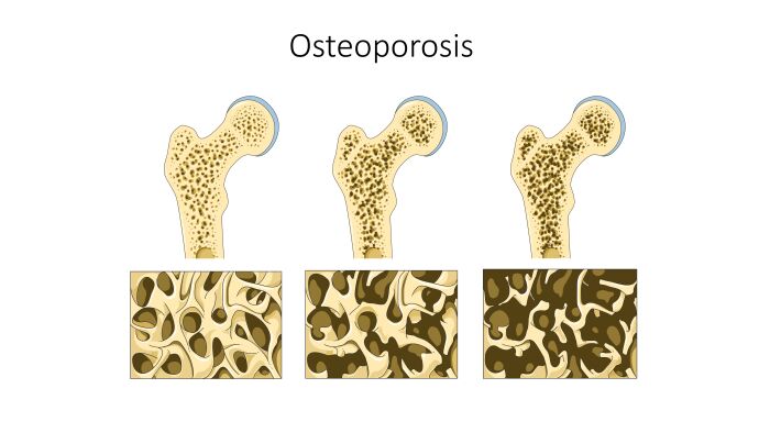 Avance de la osteoporosis