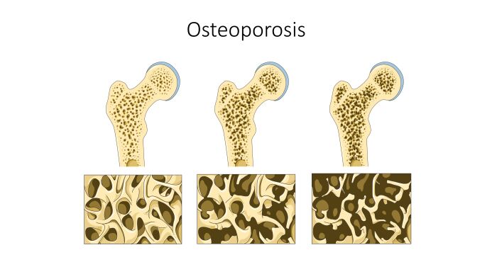 osteoporosis