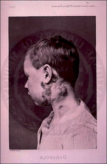 Paciente escrofuloso. Foto de 1893.