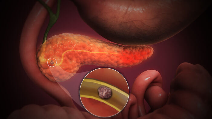 Imagen fija de animacin mdica del pncreas que muestra pancreatitis aguda