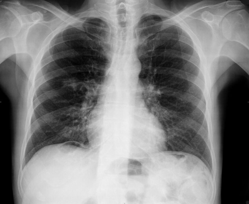 Radiografía pulmonar de una brionquitis