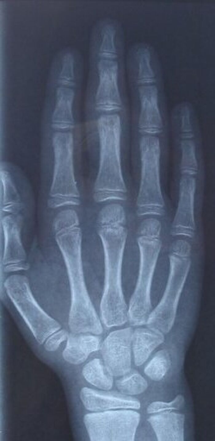 Radiografa de una mano