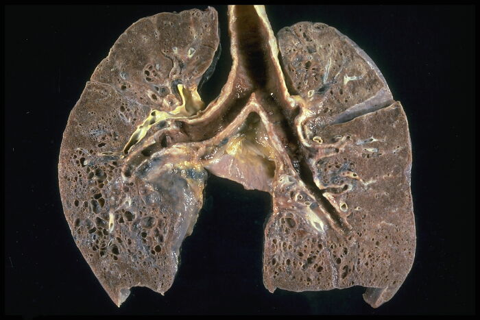 Pulmones afectados de sarcoidosis