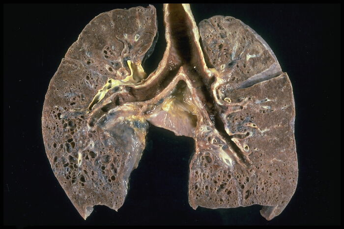 sarcoidosis