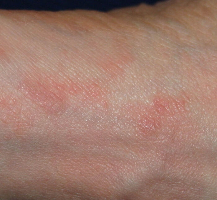 Signos de escabiosis en la piel