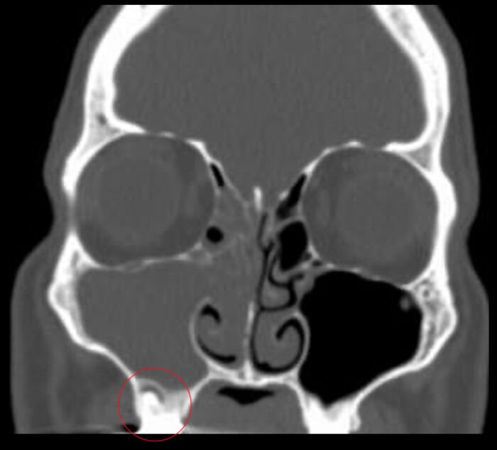 Sinusitis