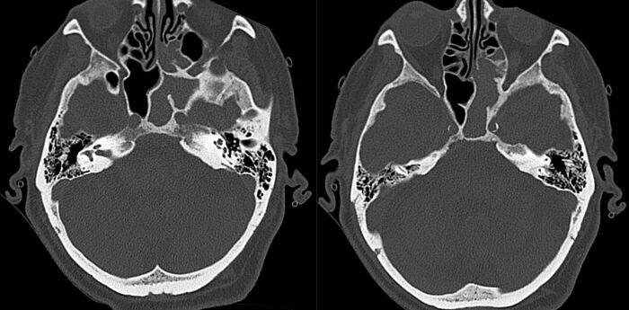 Sinusitis