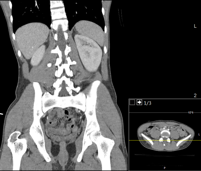 Tomografa del abdomen y pelvis