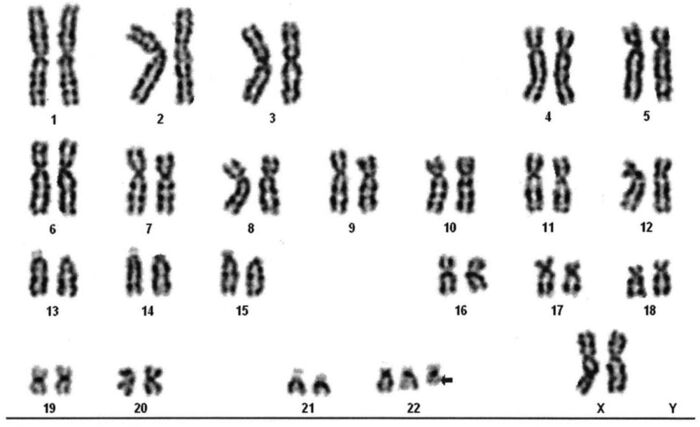 Trisoma del 22