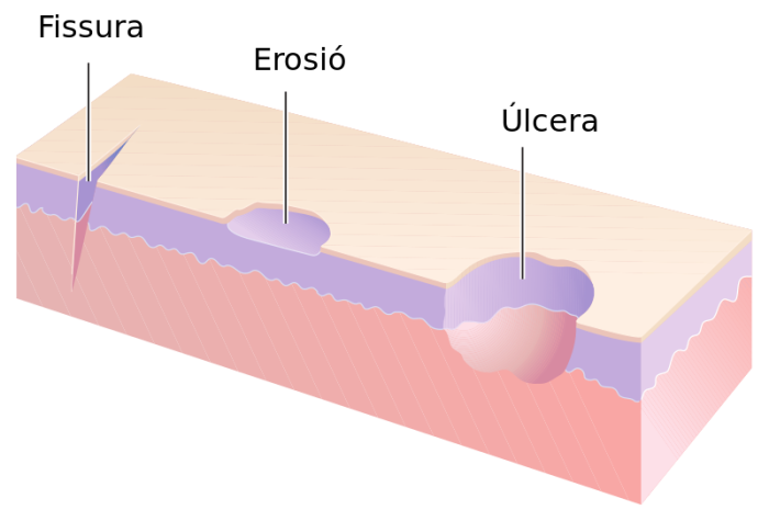 Fisura, erosin, lcera